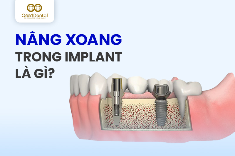 Nâng xoang trong trồng răng Implant có thực sự cần thiết?