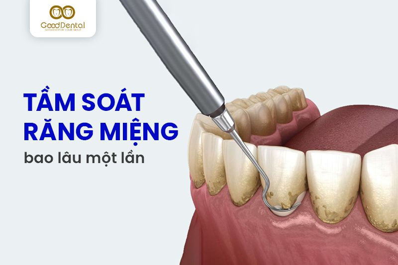 Tầm soát răng miệng định kỳ bao lâu một lần?