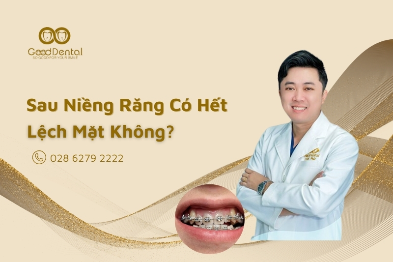 Sau Niềng Răng Có Hết Lệch Mặt Không?
