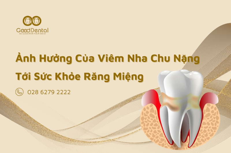 Ảnh Hưởng Của Viêm Nha Chu Nặng Tới Sức Khỏe Răng Miệng