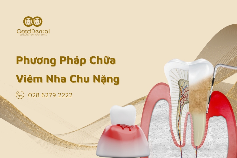 Phương Pháp Chữa Viêm Nha Chu Nặng