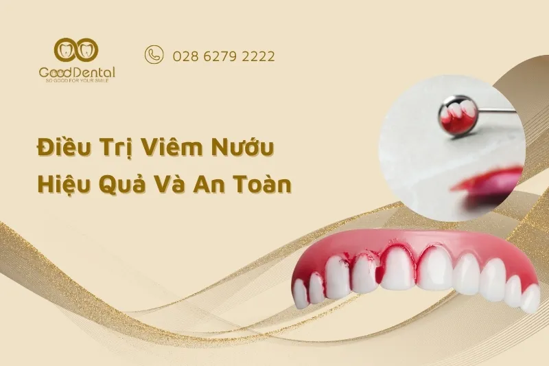 Điều Trị Viêm Nướu Hiệu Quả Và An Toàn