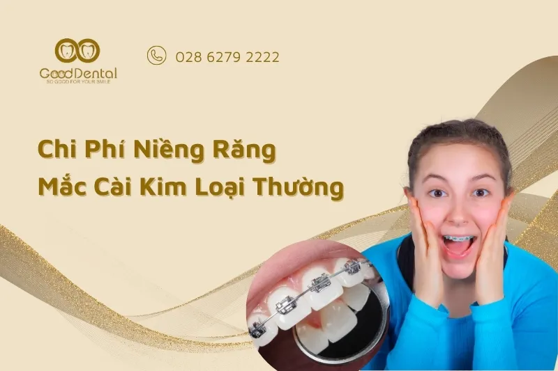 Chi Phí Niềng Răng Mắc Cài Kim Loại Thường Bao Nhiêu?