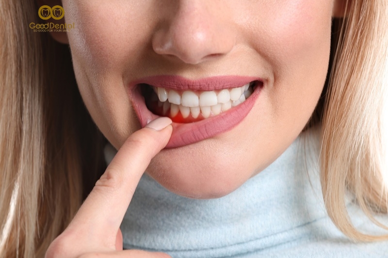 Viêm Nha Chu Nhẹ? Dấu Hiệu Và 4 Cách Chữa Trị Tại Nhà