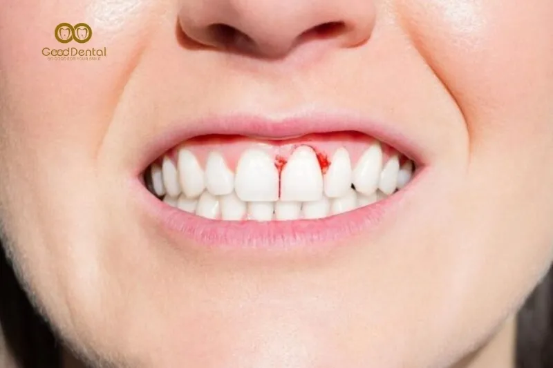 Bí Quyết Từ Chuyên Gia Trước Và Sau Điều Trị Nha Chu