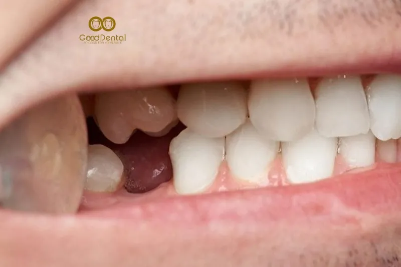 Mất Răng Có Niềng Được Không?