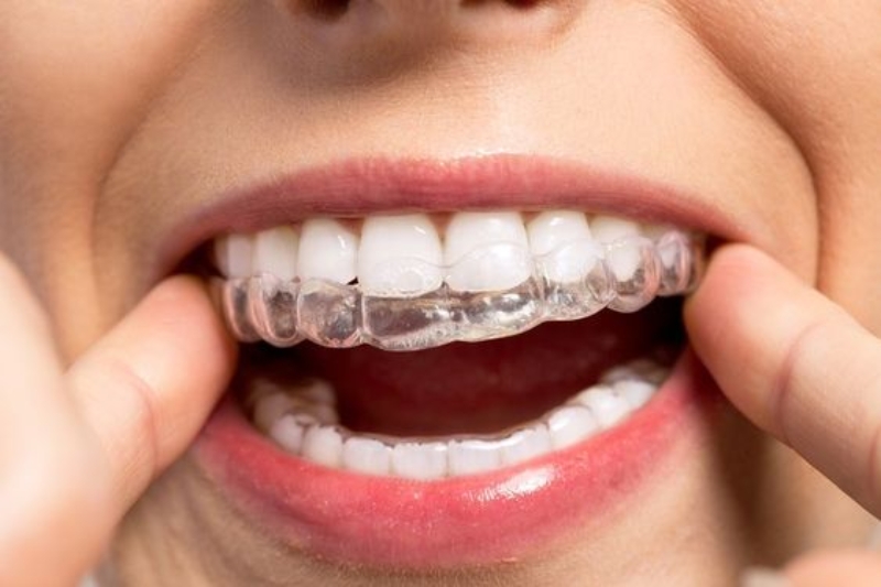 Niềng răng Invisalign - Nụ cười hoàn hảo, trải nghiệm thoải mái