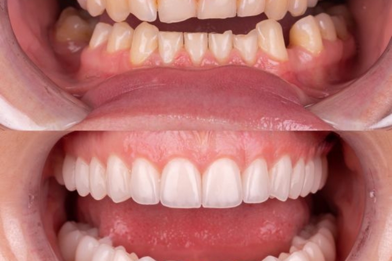 Dán Sứ Veneer Là Gì?