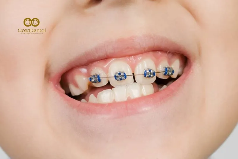 Niềng Răng 1 Hàm Được Không? Trường Hợp Nào Niềng 1 Hàm?