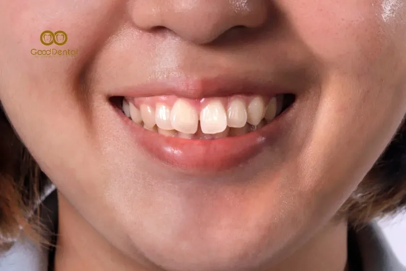 Hình Ảnh Răng Hô Nặng Và Giải Pháp Niềng Răng Cho Răng Hô Nặng