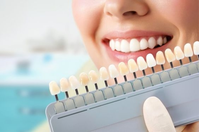 Bật Mí Công Nghệ Dán Răng Sứ Mới Nhất, Nhanh Chóng, An Toàn
