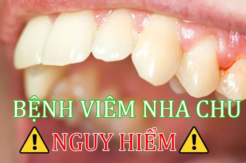 Bệnh nha chu có nguy hiểm không?