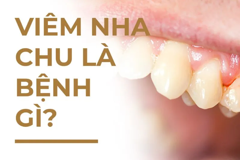 Bệnh viêm nha chu là gì?