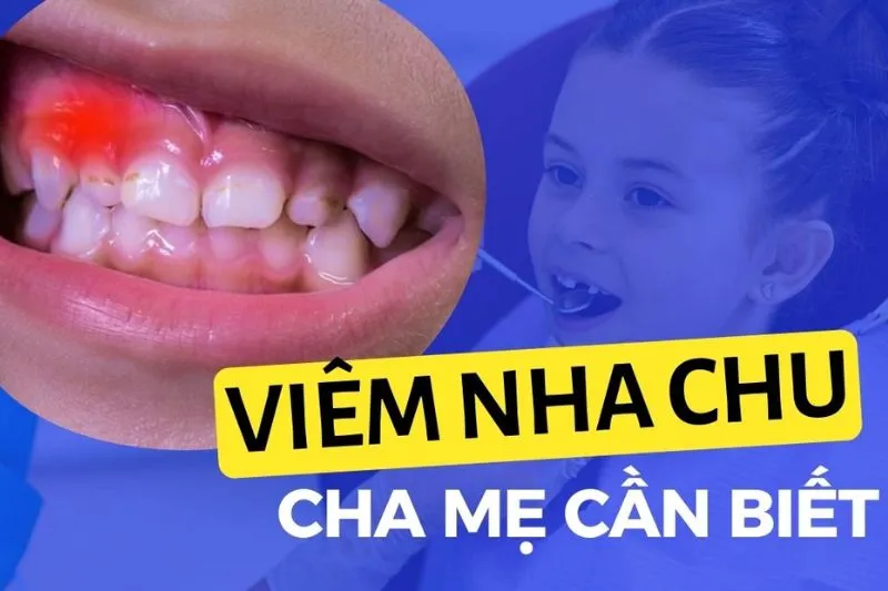 Biểu hiện viêm nha chu ở trẻ em