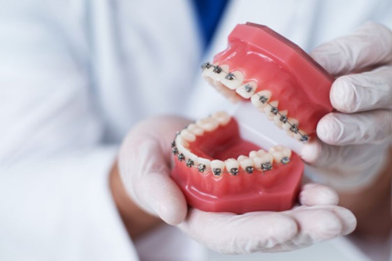 Có Nên Nhổ Răng Số 4 Để Niềng Không?