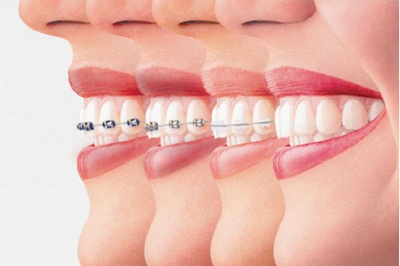 Tìm hiểu về 4 giai đoạn niềng răng cho người mới