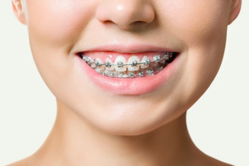 Top 5 Tác Dụng Của Niềng Răng Mang Lại