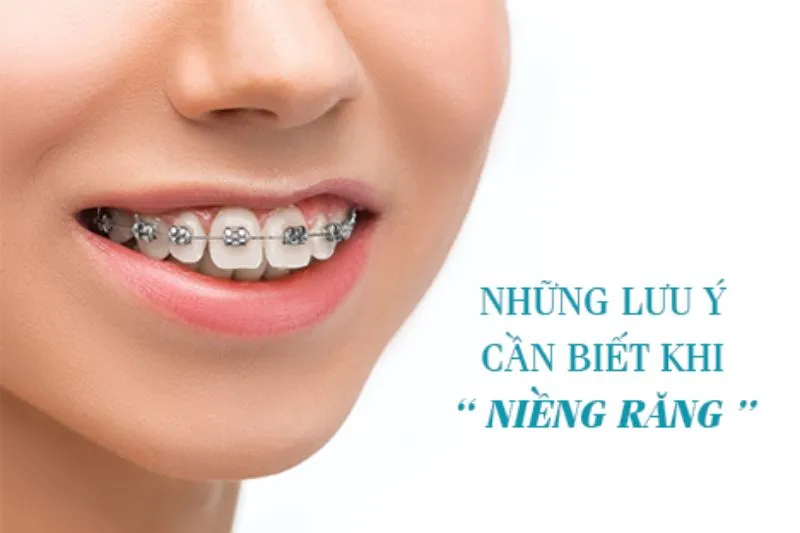 Các lưu ý khi niềng răng