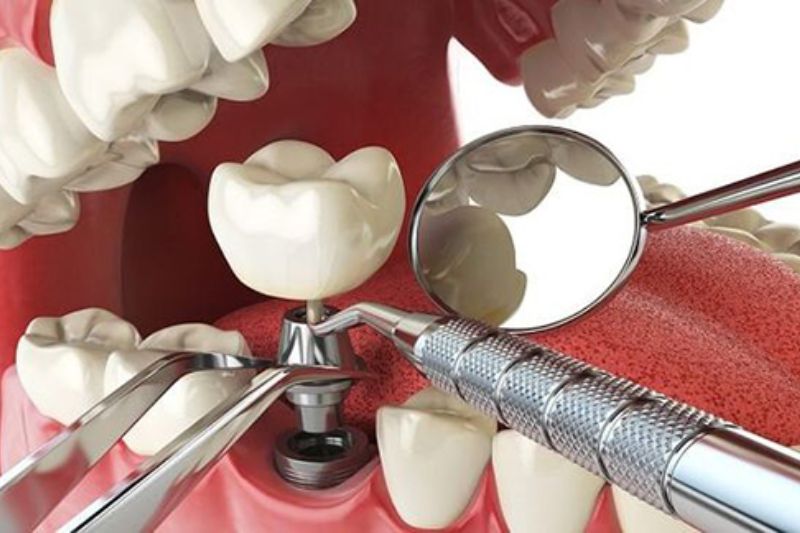 Mất Răng Có Niềng Được Không?