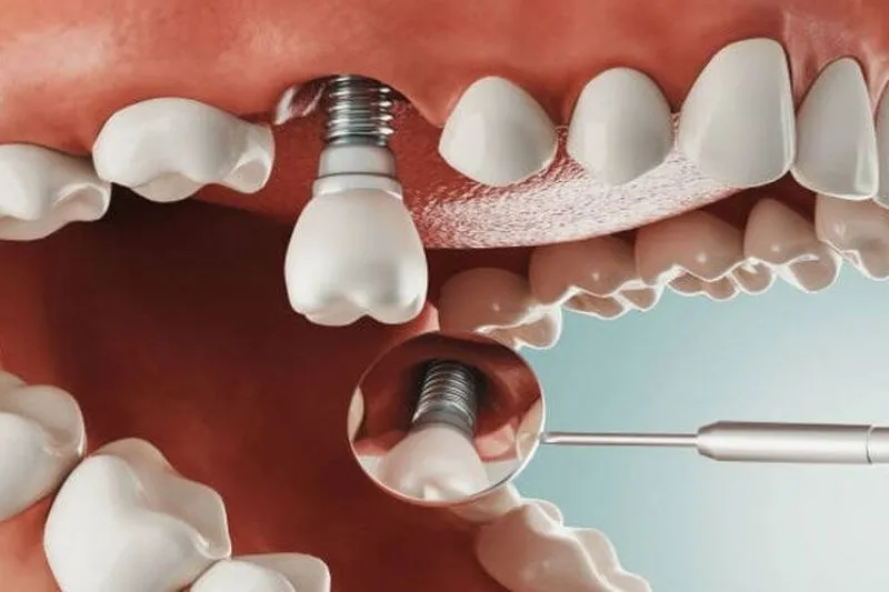 Hình Ảnh Cầu Răng Sứ Trên Trụ Implant