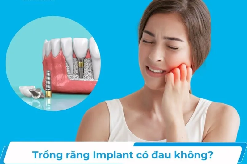 Cấy Implant có đau không?