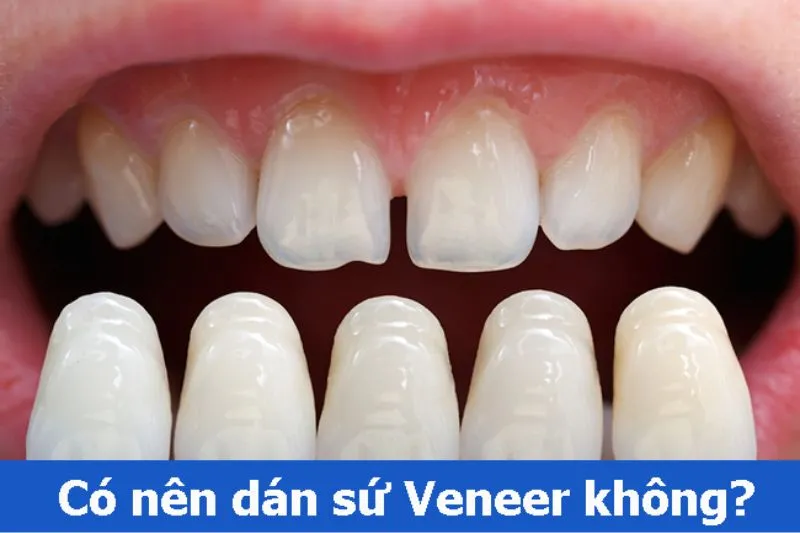 Có nên dán răng sứ không? 5 nha khoa dán răng uy tín