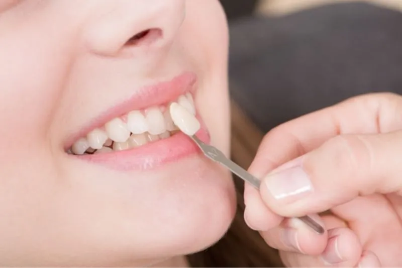 Ảnh răng sứ: dán veneer