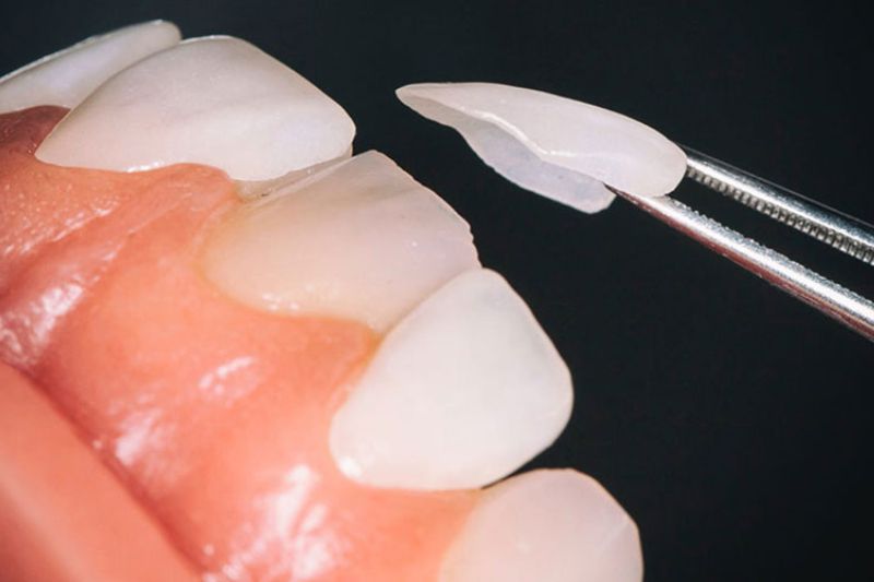 Dán răng sứ Veneer là gì? Ưu – Nhược điểm của dán răng sứ?