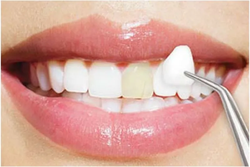 Ảnh răng sứ, răng sứ là gì?