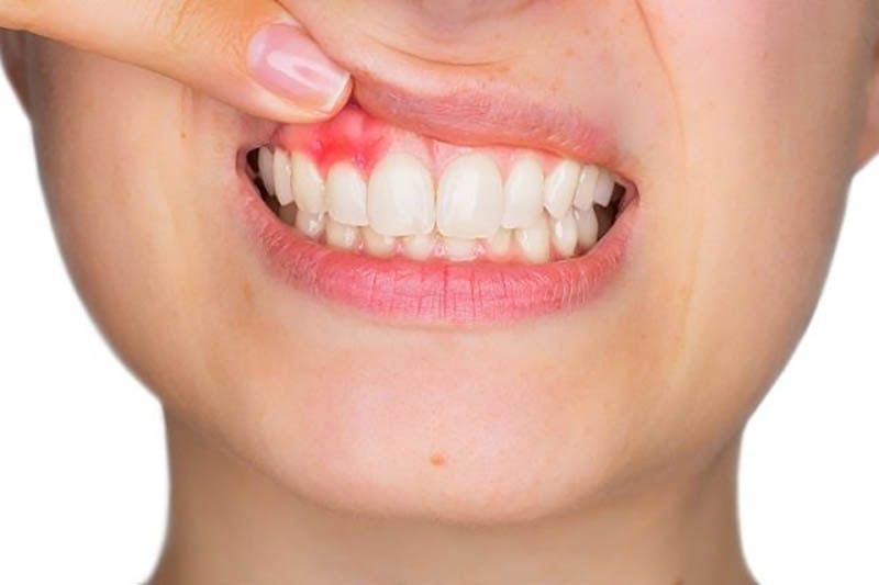 Các dấu hiệu viêm nha chu cần chú ý