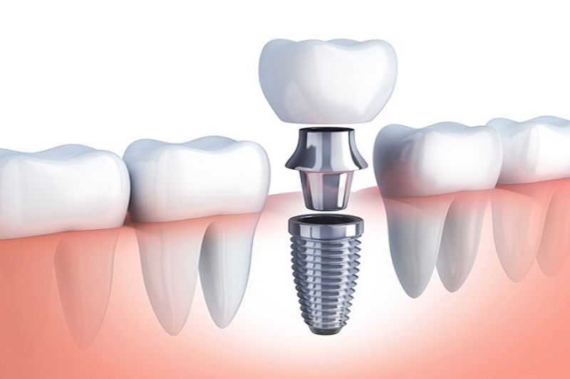 Những Lưu Ý Quan Trọng Khi Thực Hiện Cấy, Ghép Implant