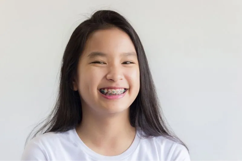Độ Tuổi Nào Thích Hợp Để Niềng Răng? 