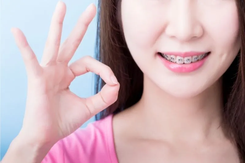 Niềng Răng Có Hôn Được Không? 4 Cách Hôn An Toàn Khi Niềng