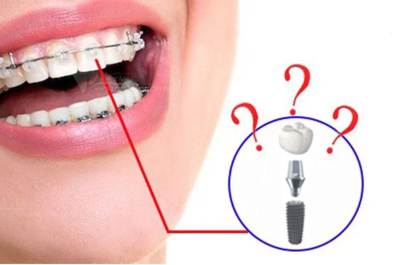 Niềng răng Implant có thể kết hợp không? Cần lưu ý những gì?