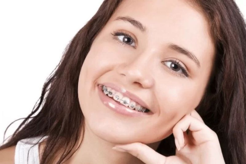 Mới Niềng Răng Đau Mấy Ngày - Khắc Phục Đau Răng Sau Niềng