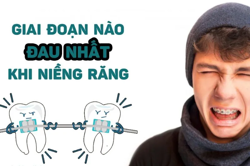 Niềng răng giai đoạn nào đau nhất?