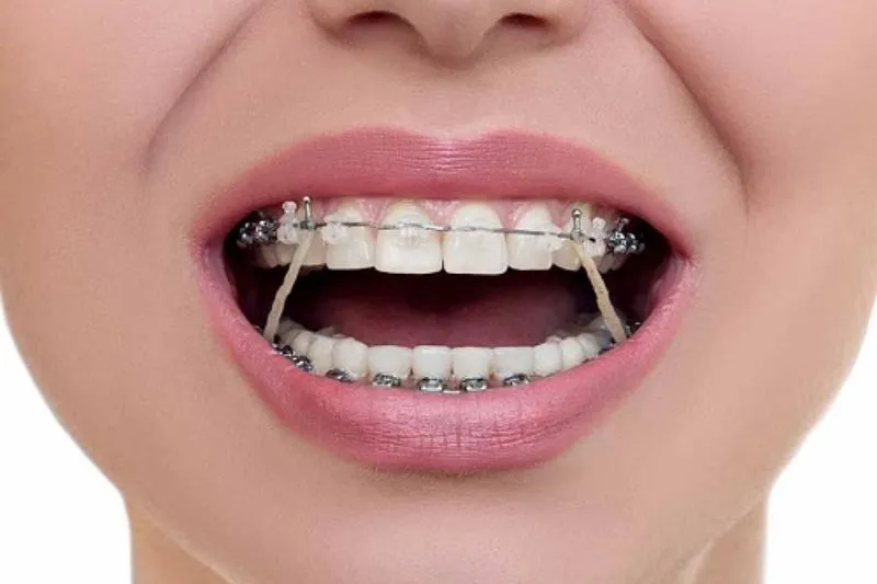 Niềng Răng Có Đau Không? Cách Giảm Đau Khi Niềng