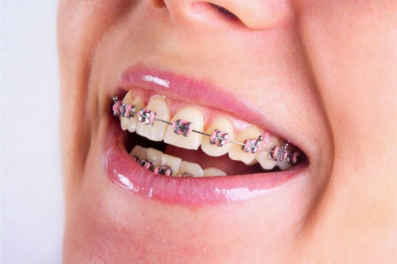 5 địa chỉ niềng răng trả góp cho sinh viên uy tín và chất lượng