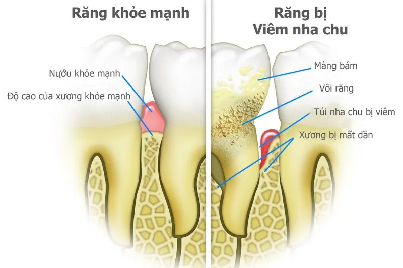 Răng bị nha chu có nghĩa là gì?