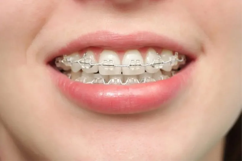 Răng Thưa Có Niềng Được Không? Thời Gian Và Phương Pháp