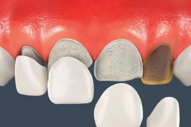 3 tác hại của dán sứ Veneer