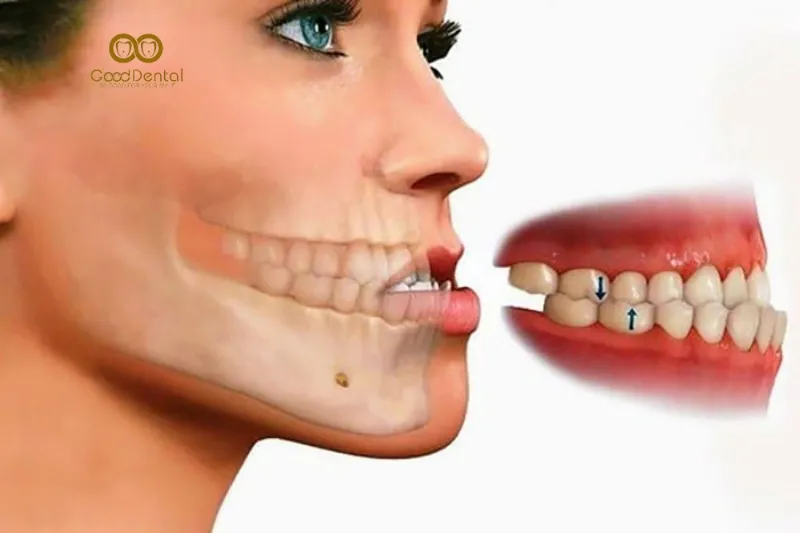 Bị Móm Có Niềng Răng Được Không? Chi Phí Niềng Răng Năm 2024?