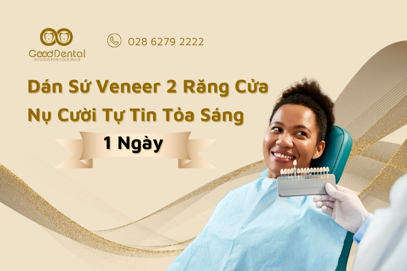 Dán Sứ Veneer 2 Răng Cửa,Nụ Cười Tự Tin Tỏa Sáng Chỉ Sau 1 Ngày!