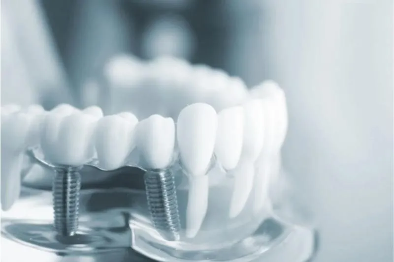 Phục Hình Răng Sứ Trên Implant Là Gì? Quy Trình Thực Hiện