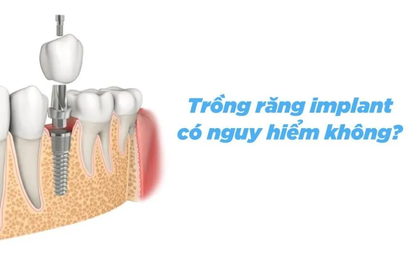 Trồng răng Implant có nguy hiểm không? Công nghệ cấy Implant 2024