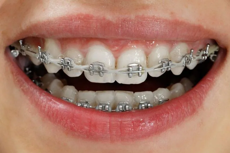 Bí Quyết Chăm Sóc Răng Miệng Hiệu Quả Trong Suốt Quá Trình Niềng Răng