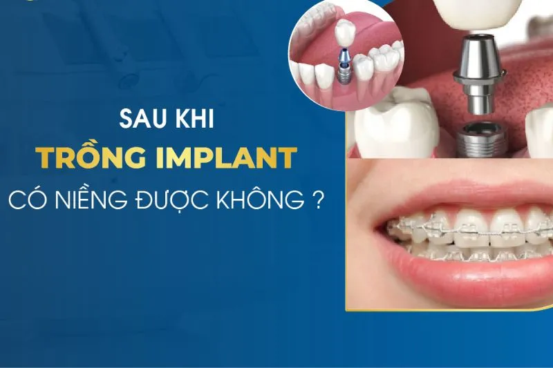 Trồng răng Implant có niềng răng được không?