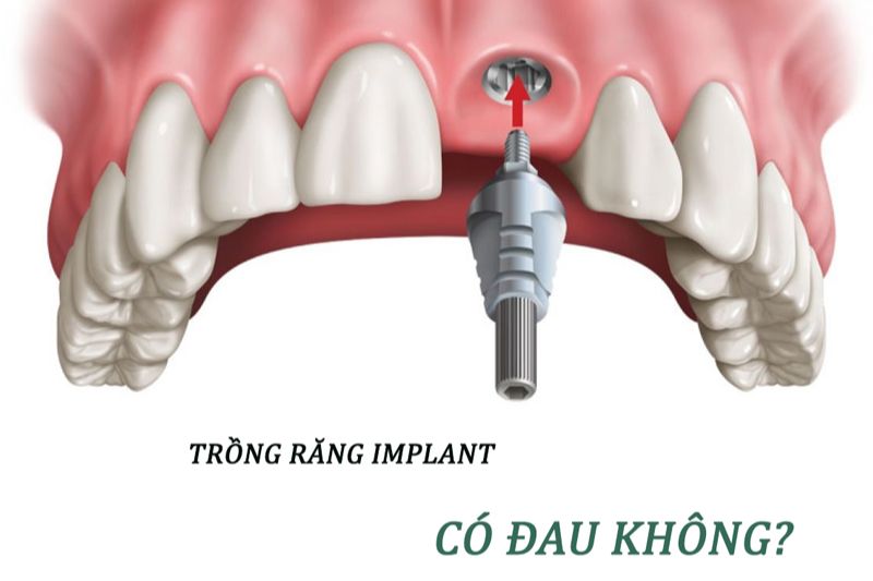 Trồng răng implant có đau không?
