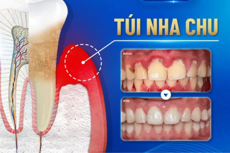 Túi nha chu là gì? 5 yếu tố gây tình trạng này
