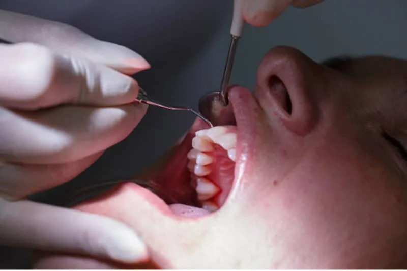 viêm nha chu có niềng răng được không?